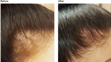 Natural Home Remedies For Hair Regrowth