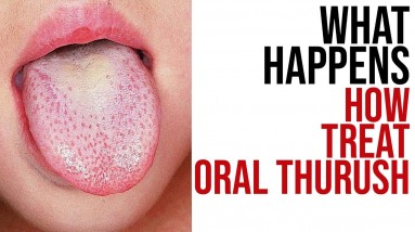 How Does ORAL THRUSH affect the body? - How To Treat ORAL THRUSH