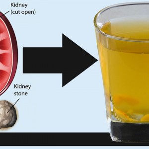 One Natural Drink To Treat KIDNY STONES