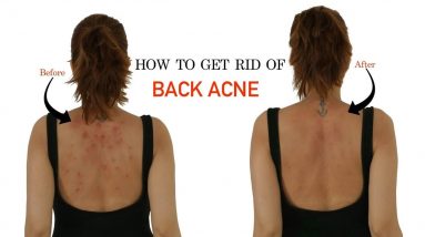 How To Get Rid of Back Acne the Natural Way - Dr. Swapna Priya