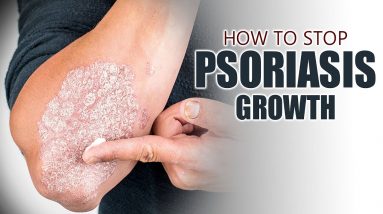 How To Stop Growth of Psoriasis || Dermatologist Dr.Uma Chakravadhanula || Orange Health