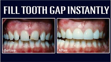 How to Instantly Fill Tooth Gap? || Dr.Vijayalakshmi about Tooth Gap