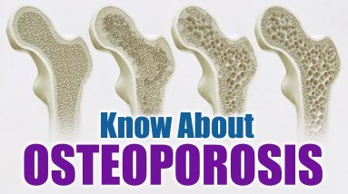 Osteoporosis - Causes, Symptoms, Diagnosis, Treatment, Pathology || Orange Health
