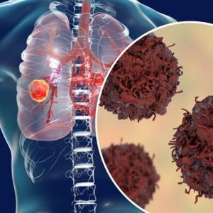 Lung Cancer - Symptoms, Types, & Treatment | Orange Health