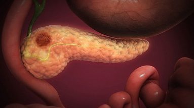 Prevention Of Acute Pancreatitis || Renova Hospitals Dr.Srimannarayana