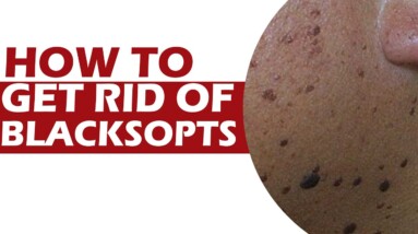 How To Get Rid Of Black spots | DR Swapna priya | ORANGE HEALTH